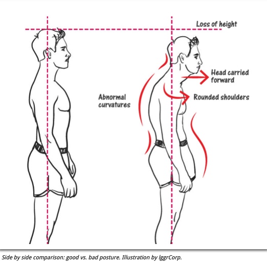 Rounded Shoulders Posture Body Alignment Forward Outline Diagram